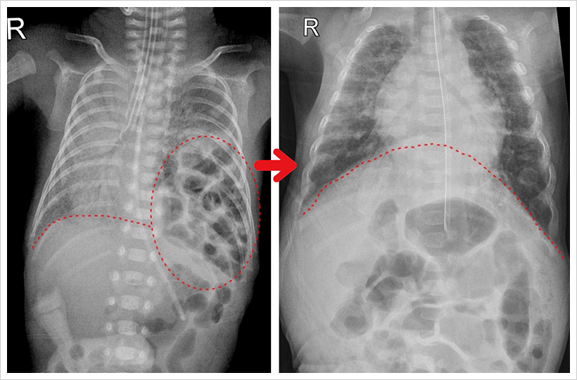 멍난 횡격막 사이로 배 속 장기들이 밀려 올라간 출생 당시의 X-ray 사진과 수술 후 횡격막을 기준으로 폐와 배 속 장기들이 잘 분리된 X-ray 사진 비교