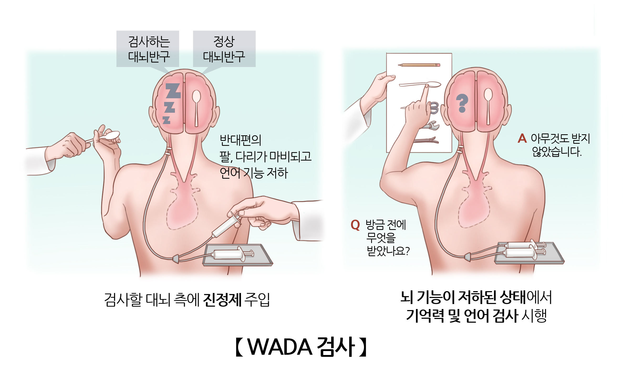 WADA 검사 | 검사/시술/수술정보 | 의료정보 | 건강정보 | 서울아산병원